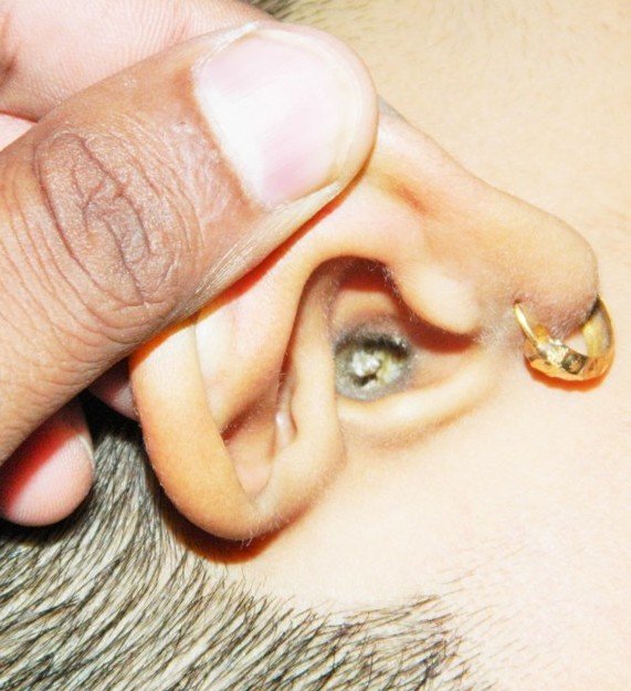 Impacted wax