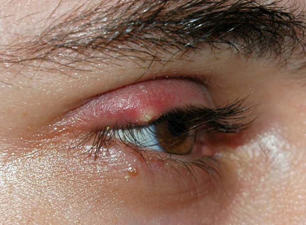 Stye (Hordeolum)