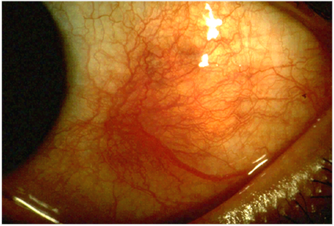 Episcleritis and Scleritis
