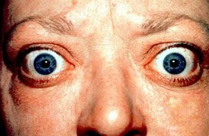 Thyroid eye disease