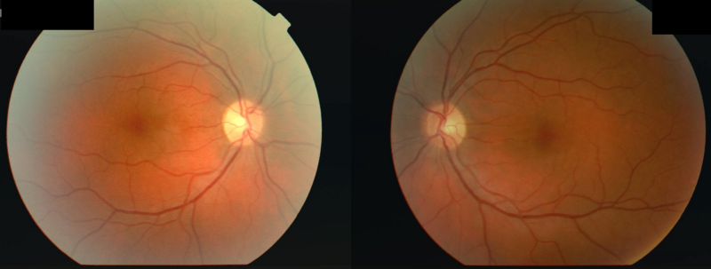 Optic neuritis