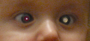 Retinoblastoma