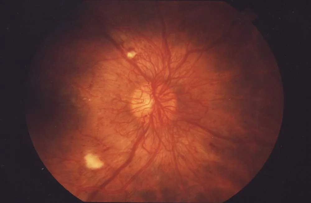 Diabetic and Hypertensive retinopathy