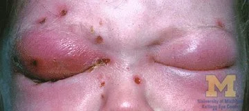 Orbital Cellulitis 