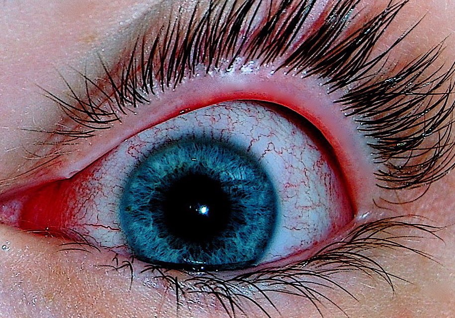Conjunctivitis 