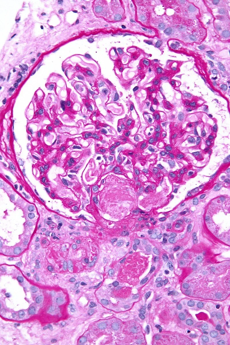 Disseminated Intravascular Coagulation (DIC)