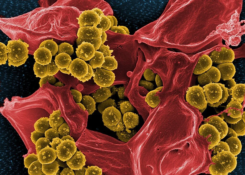 MRSA (Methicillin-resistant Staphylococcus aureus) Infection