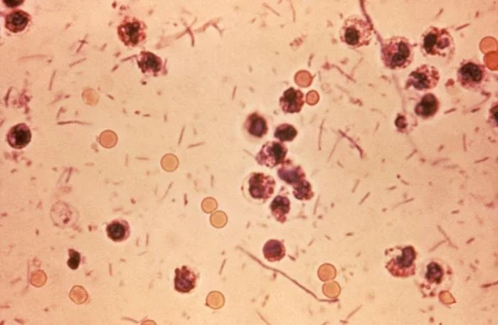 Shigella Infection