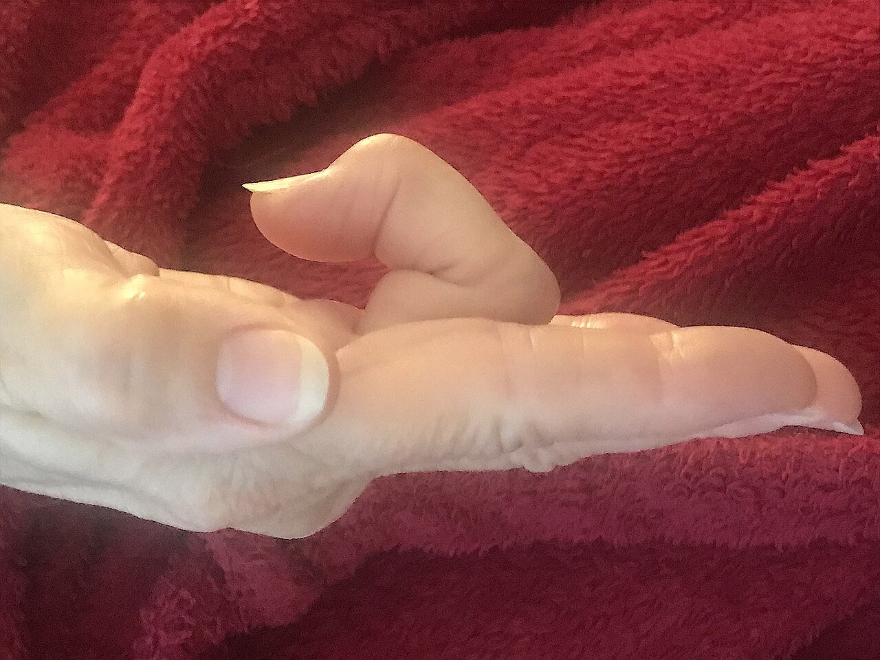 Hand, Thumb, and Finger Conditions