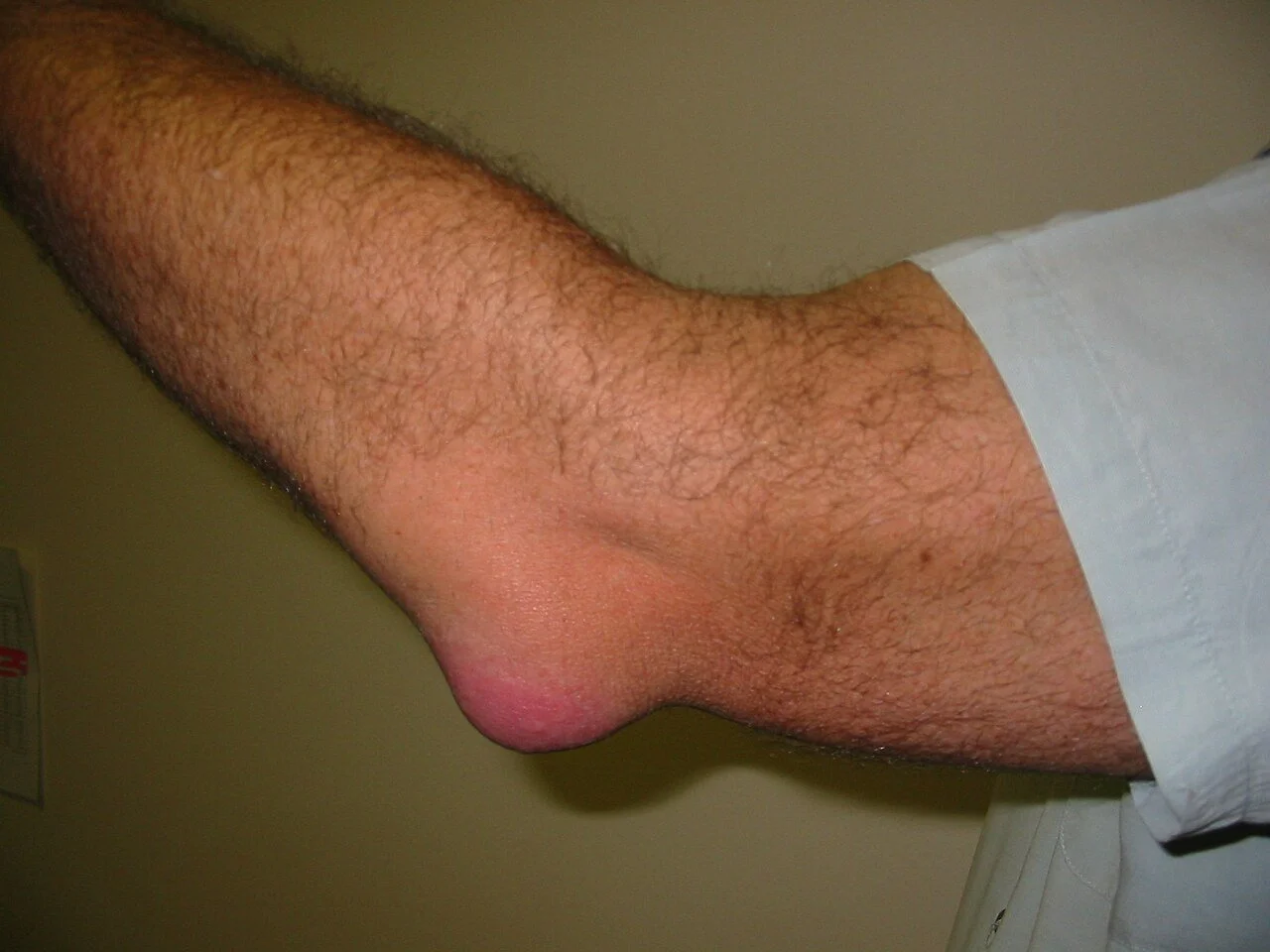 Elbow Pain