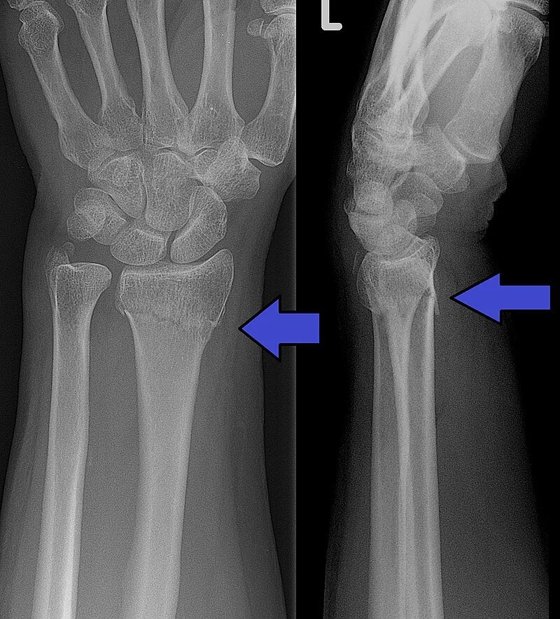 Fracture and Dislocation of the Forearm, Wrist, and Hand