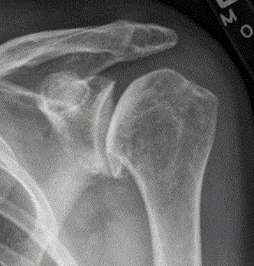 Soft Tissue Injuries of the Shoulder