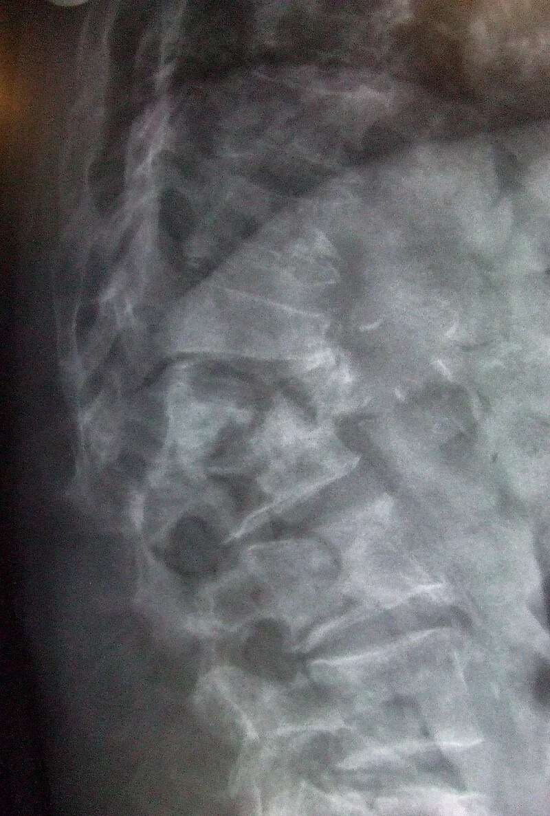 Spinal Trauma