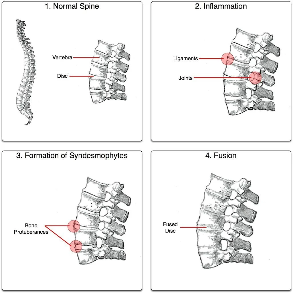 Ankylosing Spondylitis (AS)