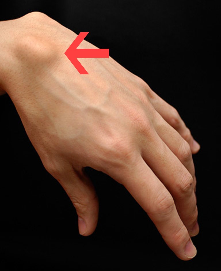 Ganglion Cyst