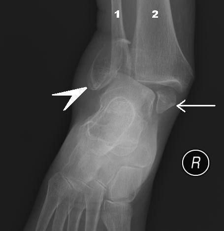 Fracture and Dislocation of the Ankle and Foot