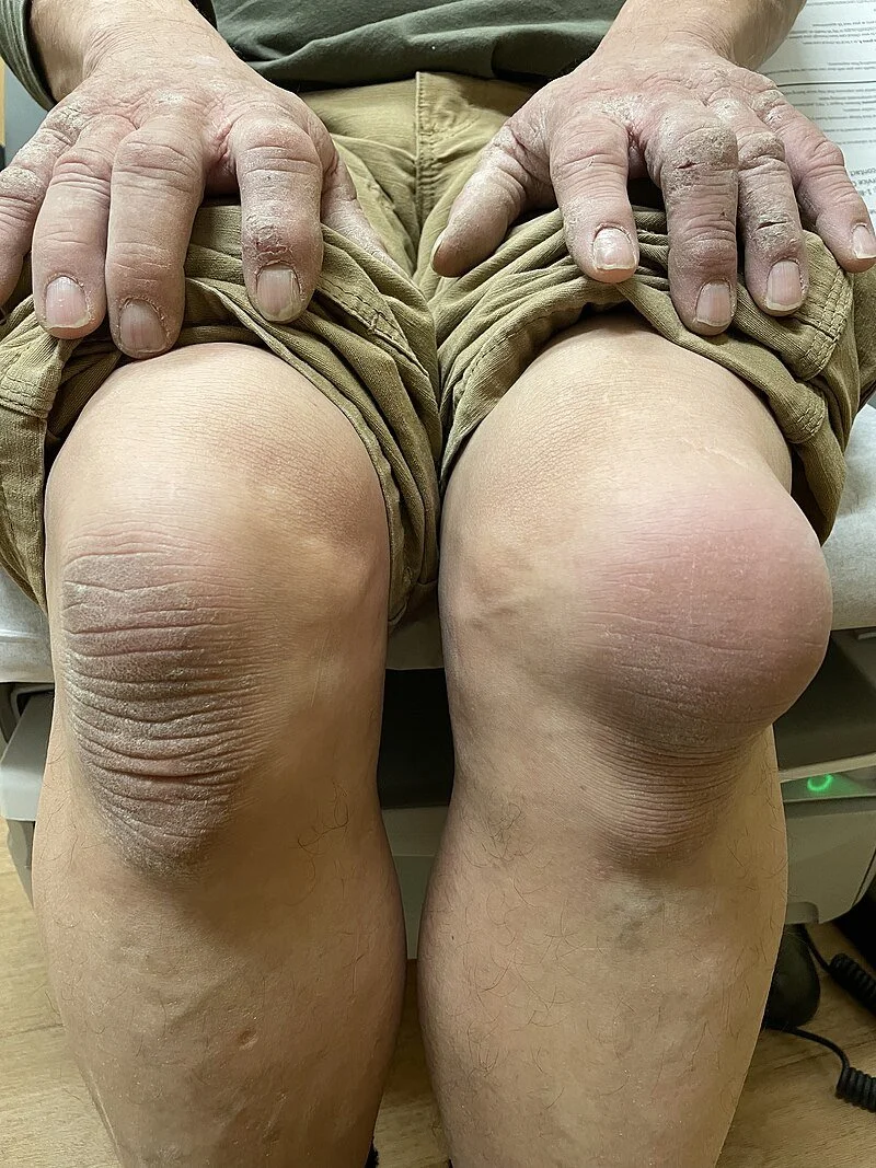 Prepatellar Bursitis