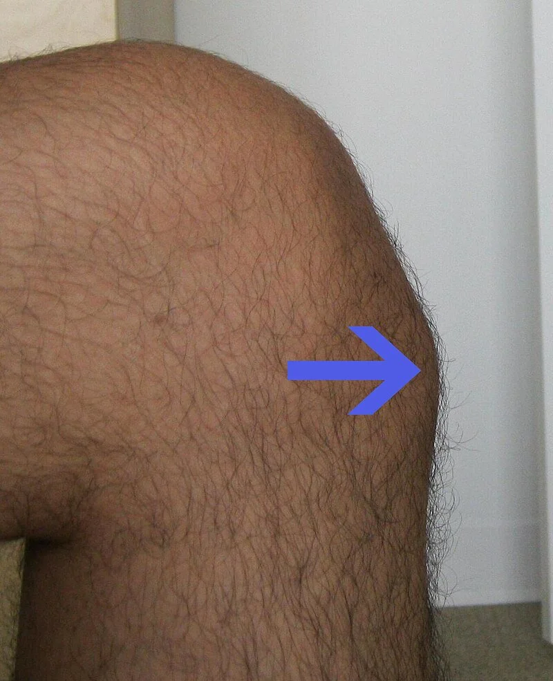Osgood-Schlatter Disease