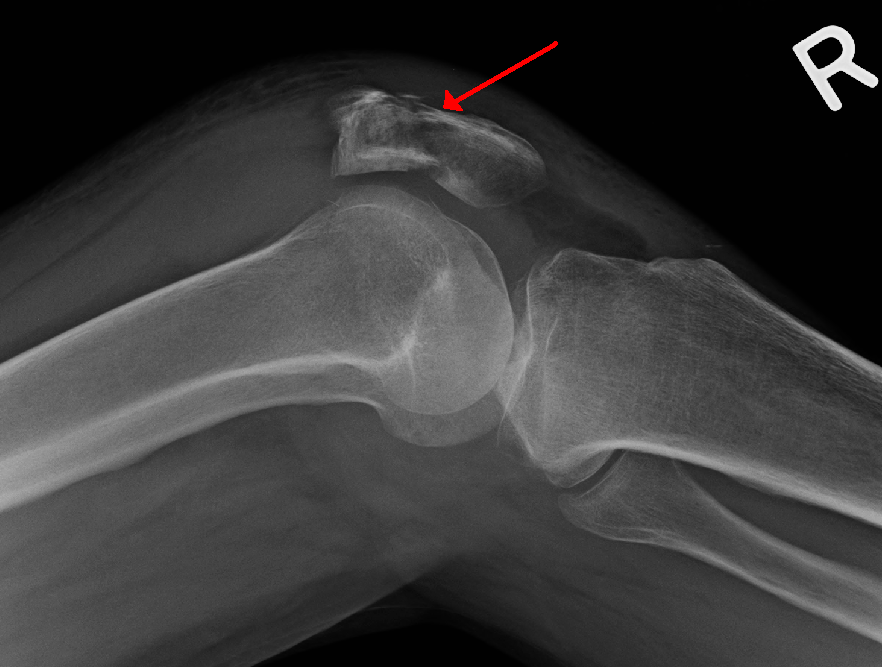 Knee Fracture and Dislocation