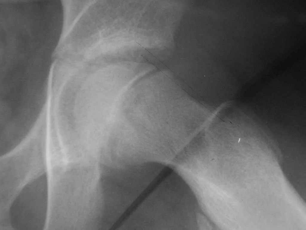 Slipped Capital Femoral Epiphysis (SCFE)