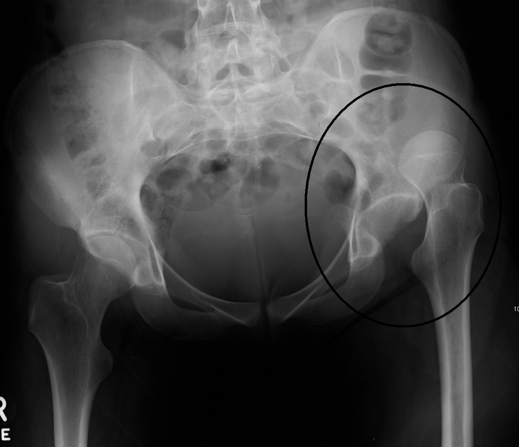 Fracture and Dislocation of the Hip