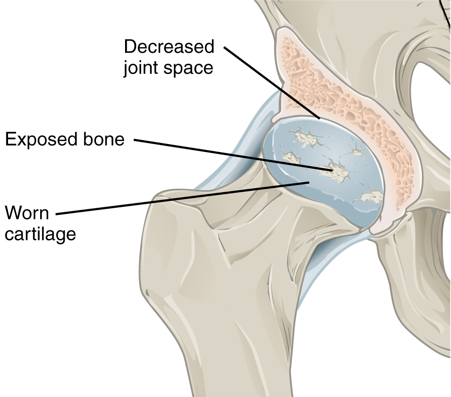 Osteoarthiritis (OA)