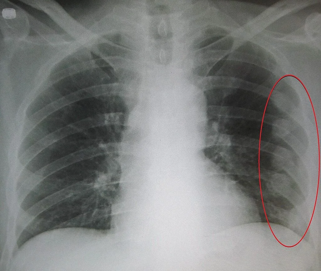 Rib Fracture