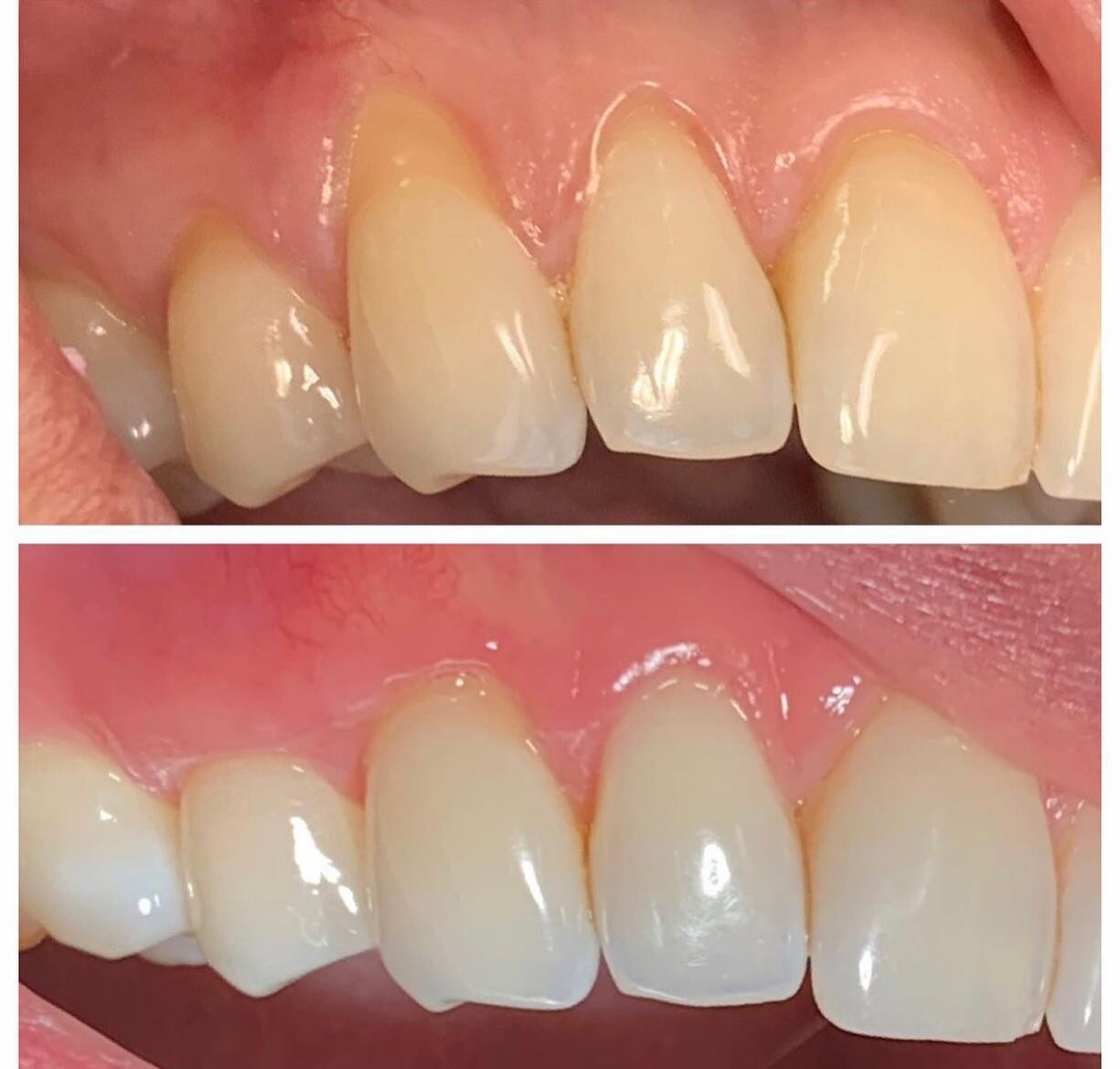 Dr. Silva&rsquo;s patient&rsquo;s before and after photos! ✨

Aggressive tooth brushing and grinding can have a detrimental effect on the gums. After the autogenous connective tissue graft, the patient reports her sensitivity is completely gone! 

Sw