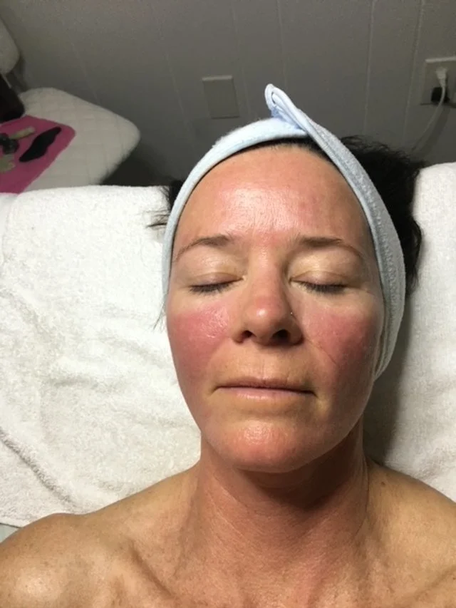 Post Botanical Peel