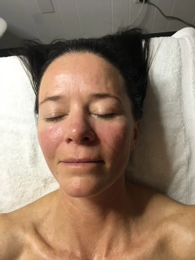 Results of 30 min. of MLD post treatment