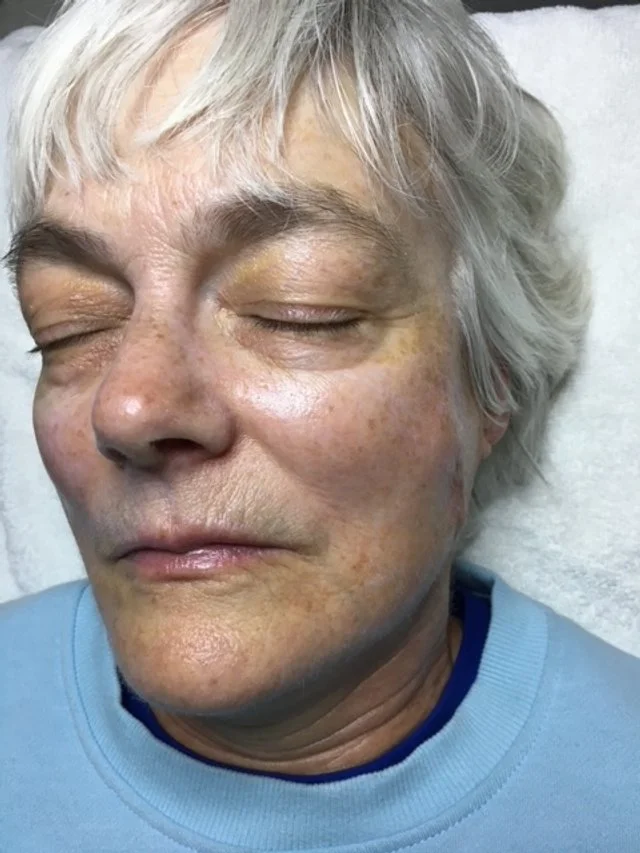 Results after Skin Rejuvenation Facial (90 min)