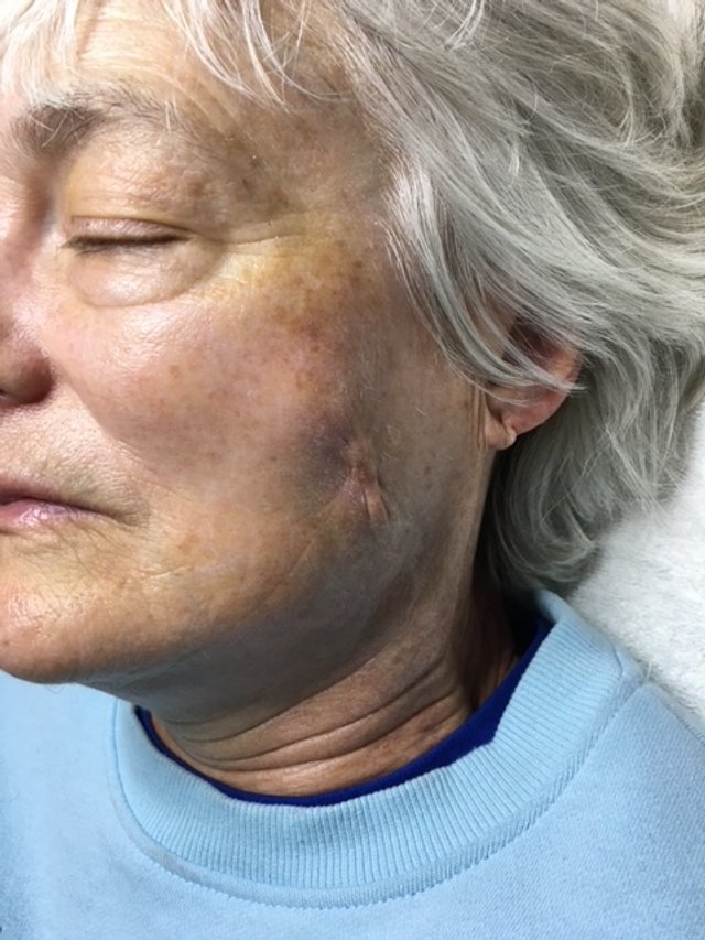 Results after Skin Rejuvenation Facial
