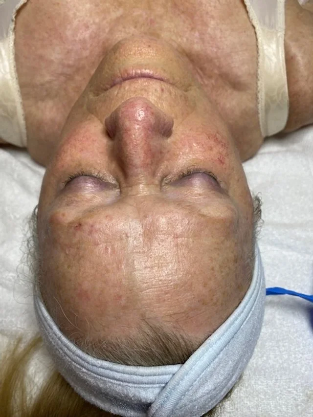 Before first Skin Rejuvenation series treatment