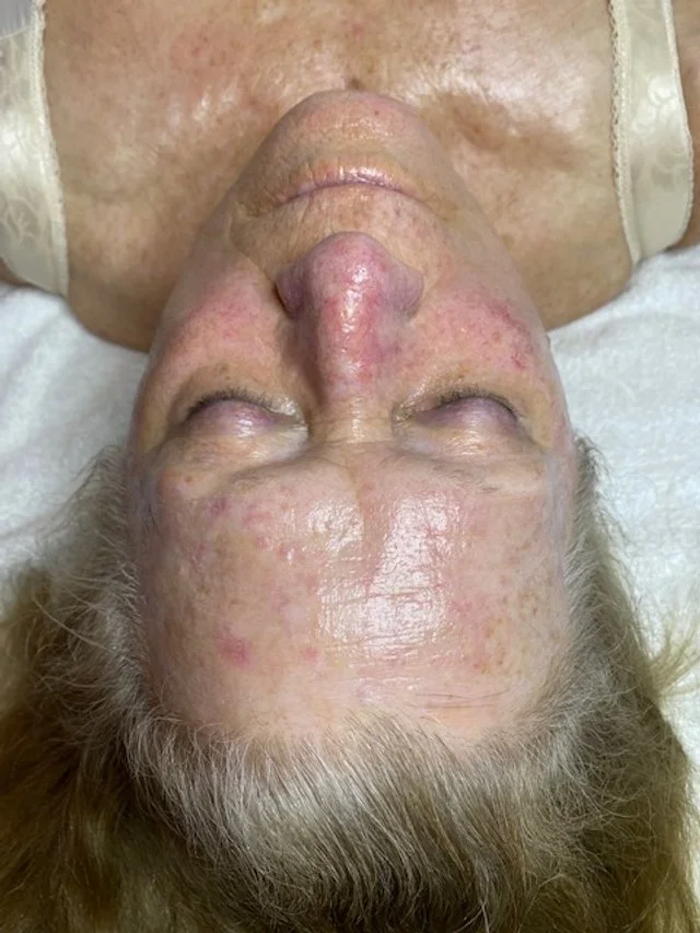 Results after one Skin Rejuvenation treatment