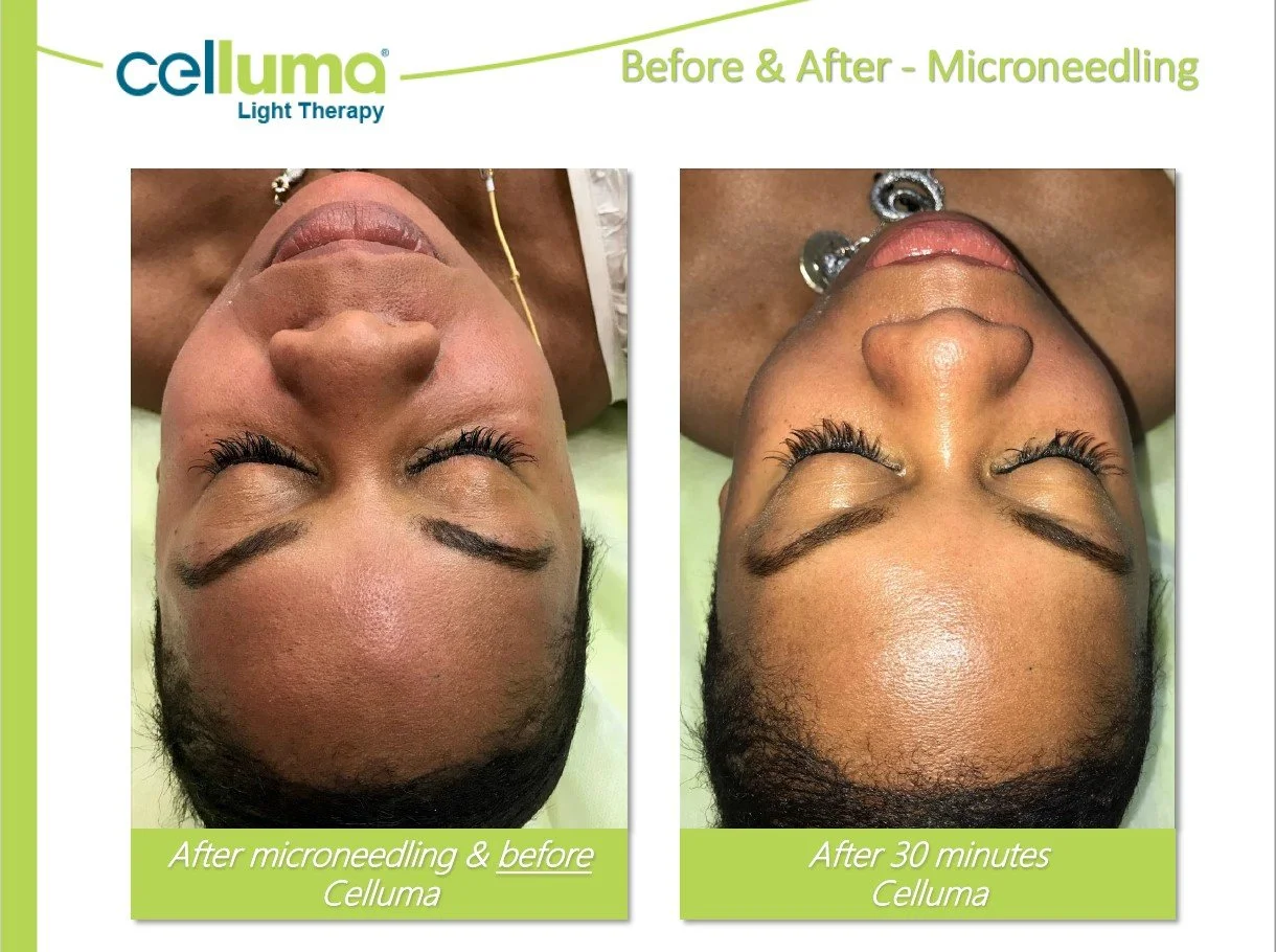denver-celluma-LED-light-therapy-skin-rejuvenation-brightening-before-and-after.jpg.jpg