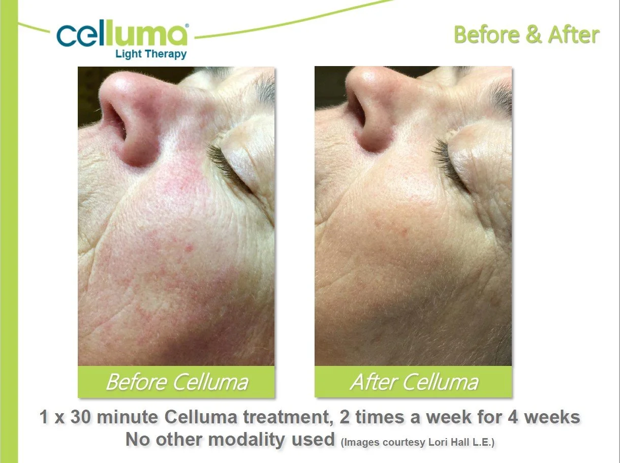 denver-celluma-light-therapy-wrinkles-and-redness-before-after.jpg.jpg