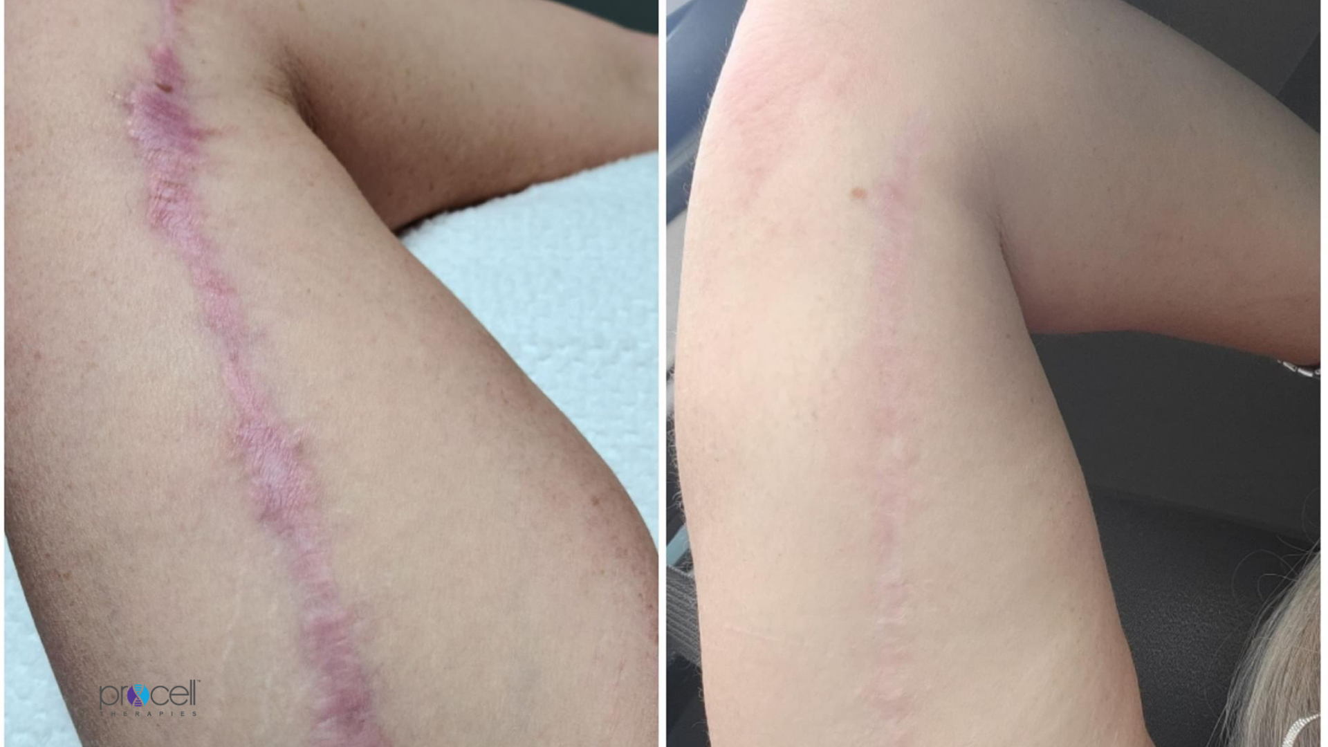 Post-surgical arm scar before and after images from treatment with Procell microchanneling (microneedling).