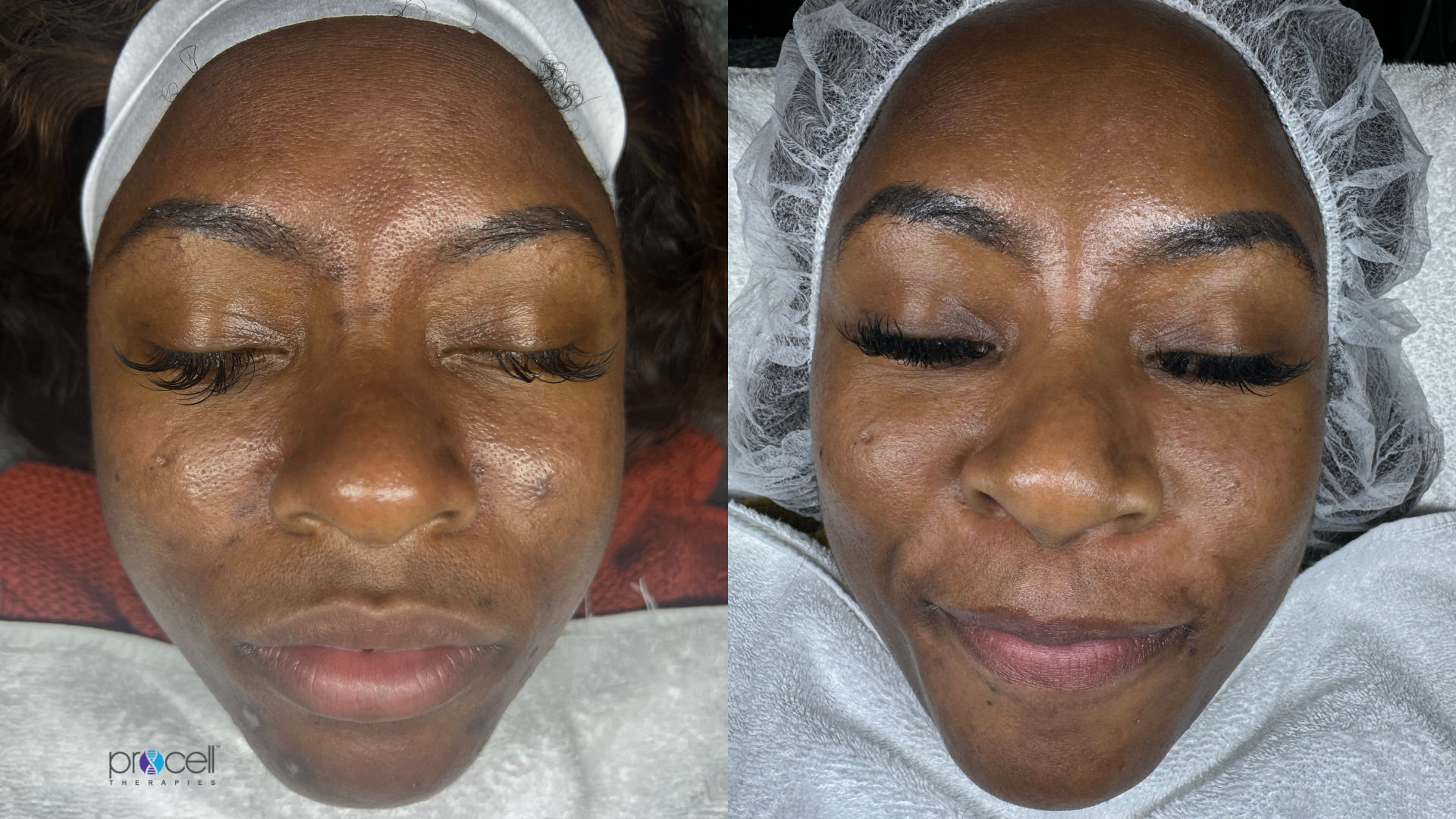 Procell microchanneling (microneedling)  treatment for skin rejuvenation and brightening before and after images.