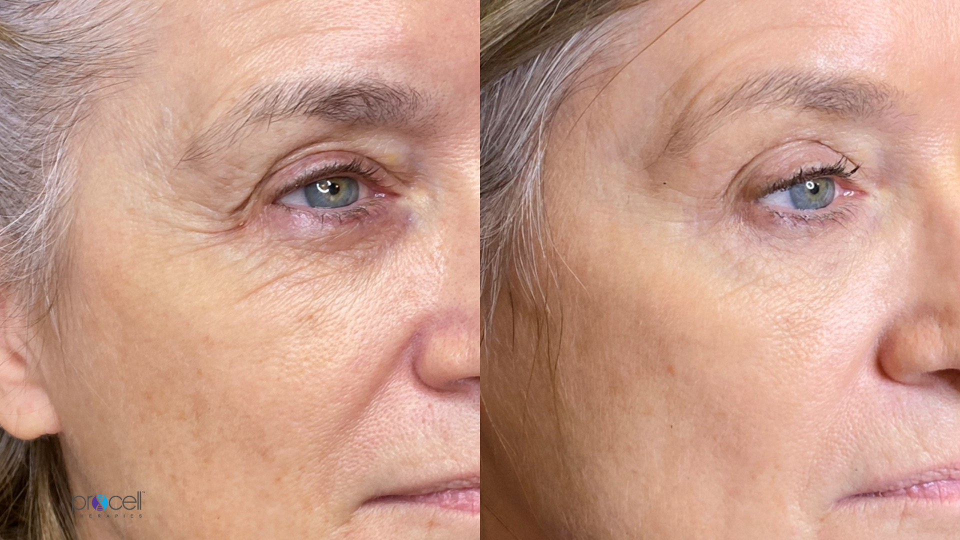 Procell microchanneling (microneedling) before and after skin tightening and rejuvenation.