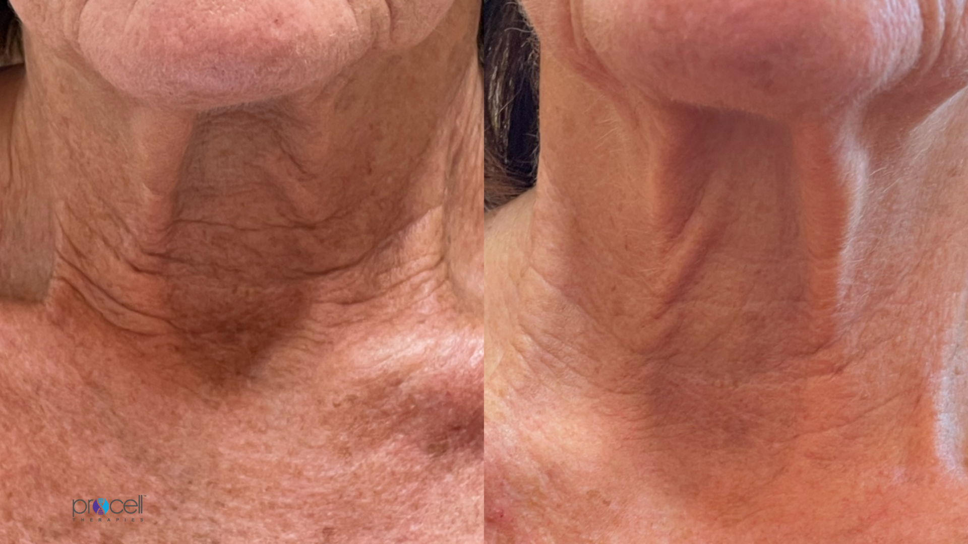 Procell microchanneling treatment for skin tightening on the neck before and after images.
