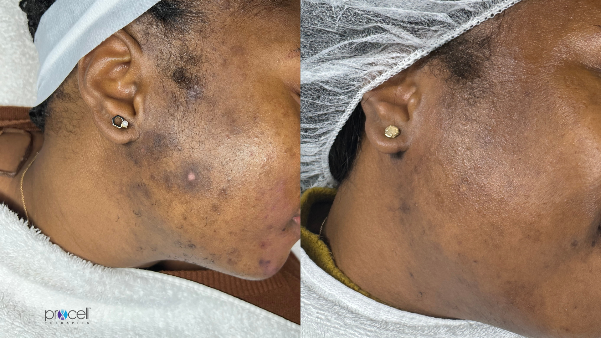 Procell microchanneling treatment before and after for scar treatment and skin brightening.
