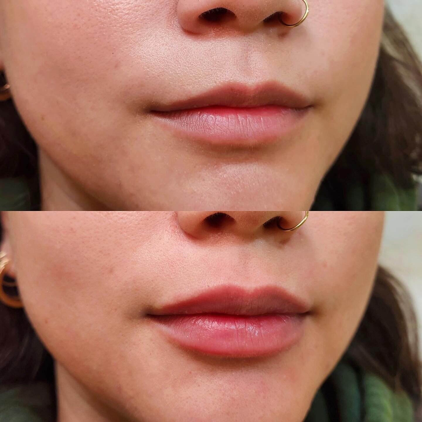 She had such beautiful lips to begin with. We gave her lips subtle volume while increasing height in her lips to balance out proportions in her lower face. 

Lips by @nurseval_ 
&mdash;&mdash;&mdash;&mdash;&mdash;&mdash;&mdash;&mdash;&mdash;
V &amp; 