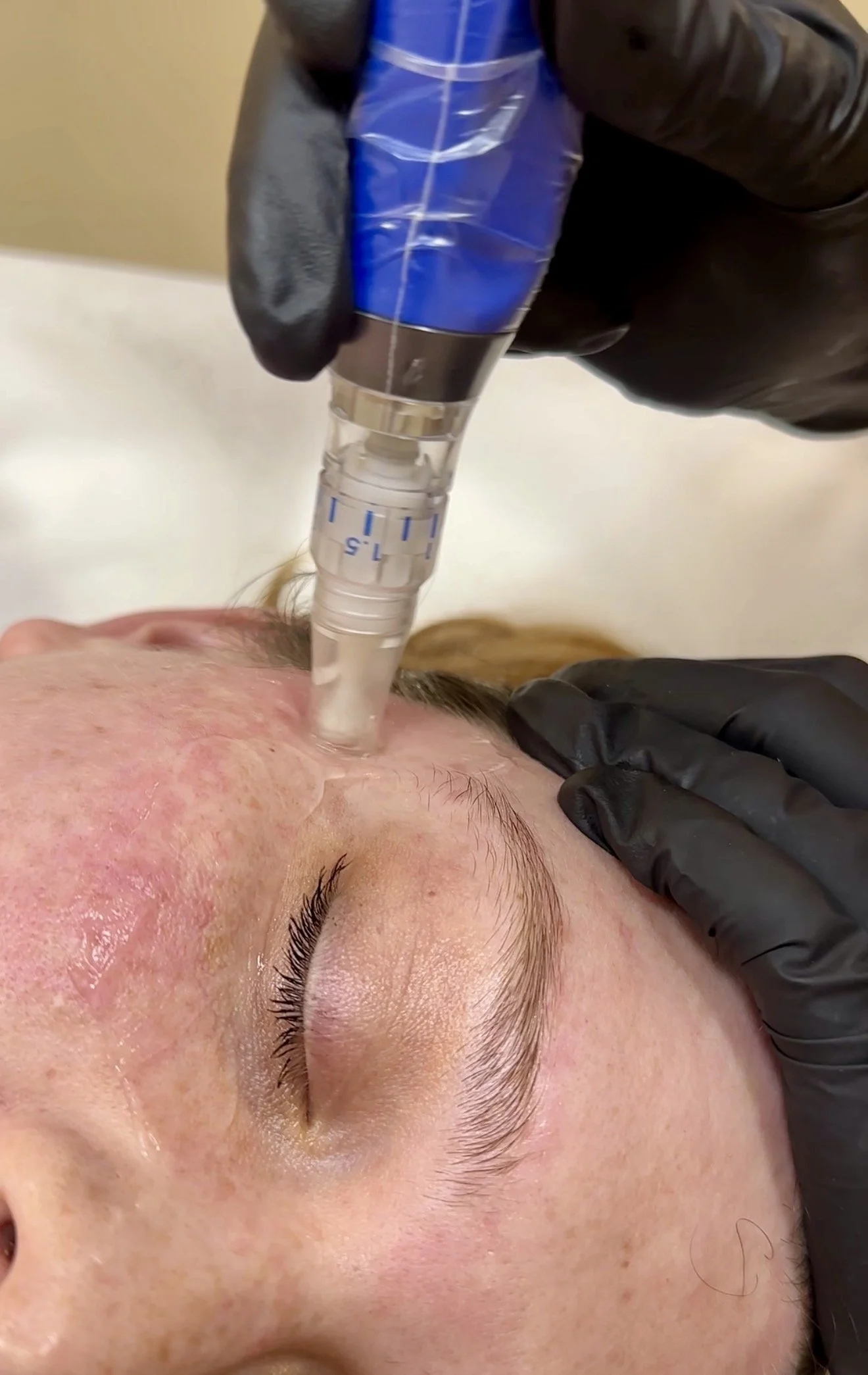Microneedling + Linder Health Peels: Your Questions, Answered