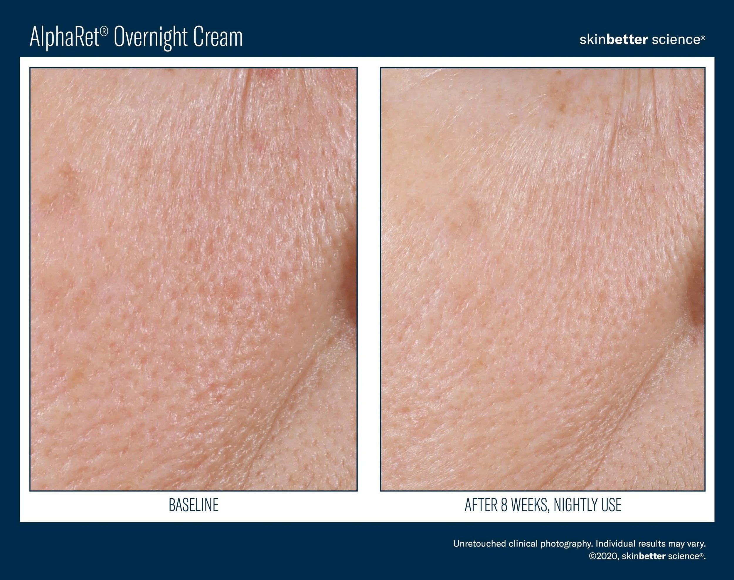 AlphaRet Overnight Cream Before & After Photo 12.jpg
