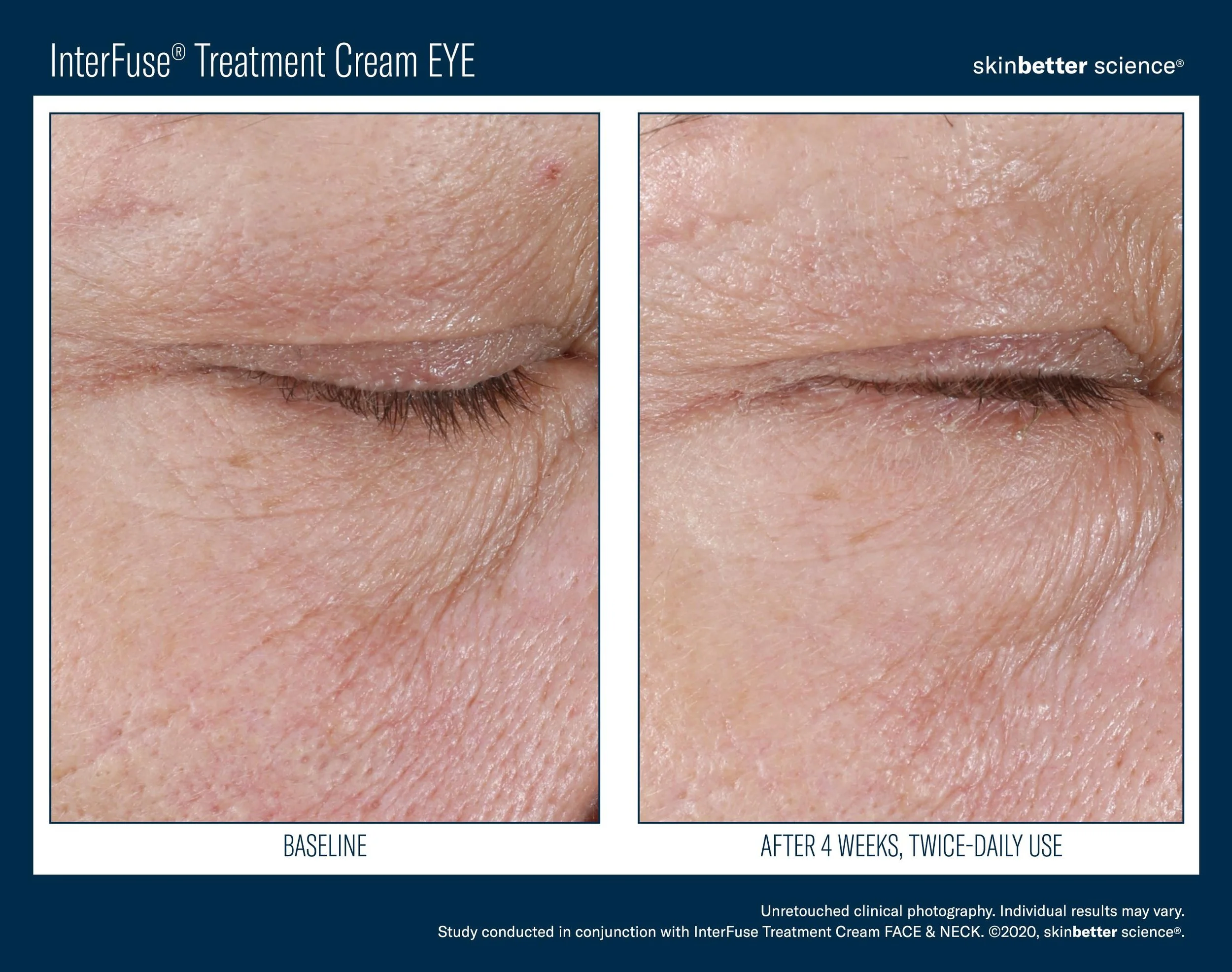 InterFuse EYE Before _ After Template-9.jpg