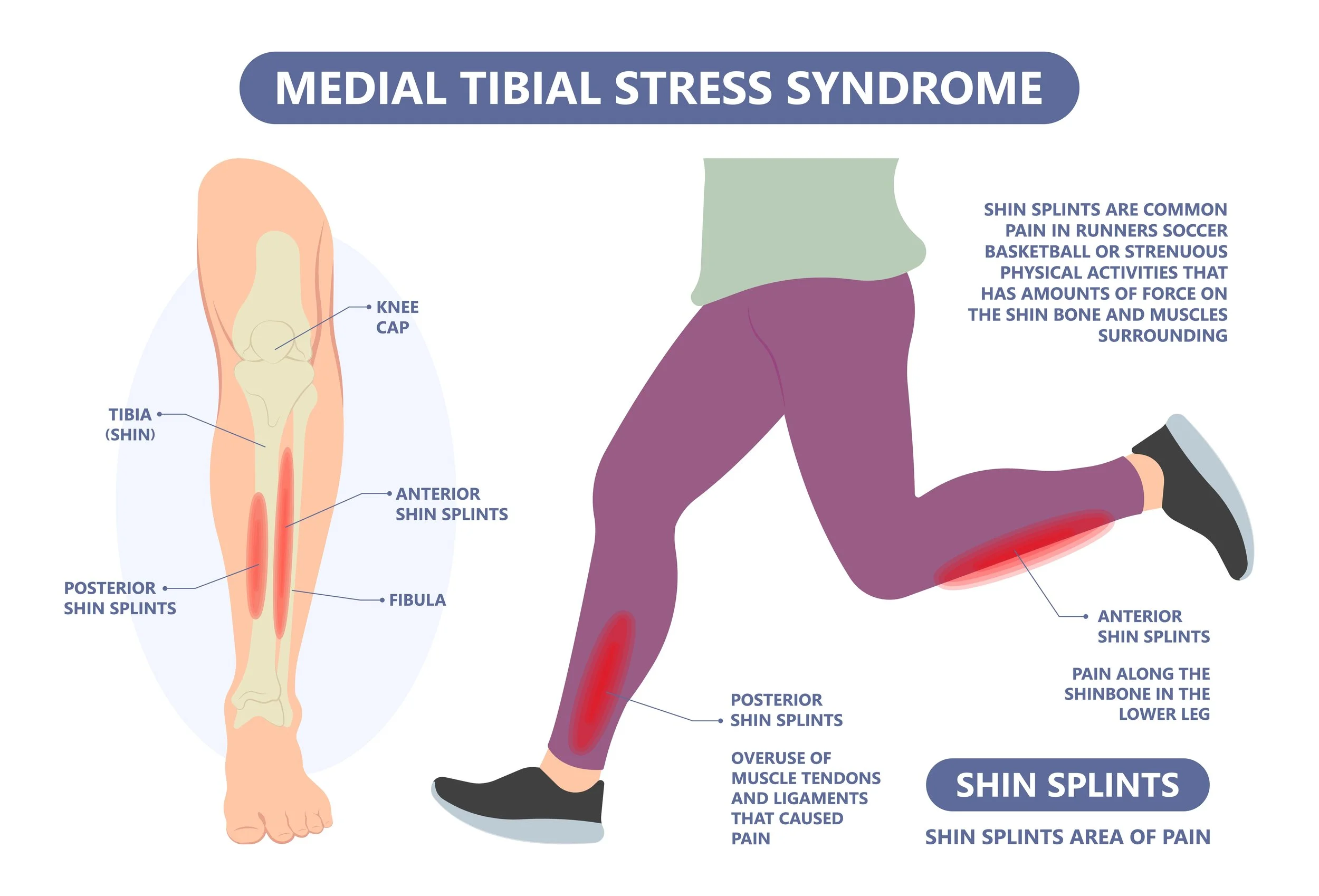 Shin Splints: What They Are, How to Spot Them, and When to Get Help