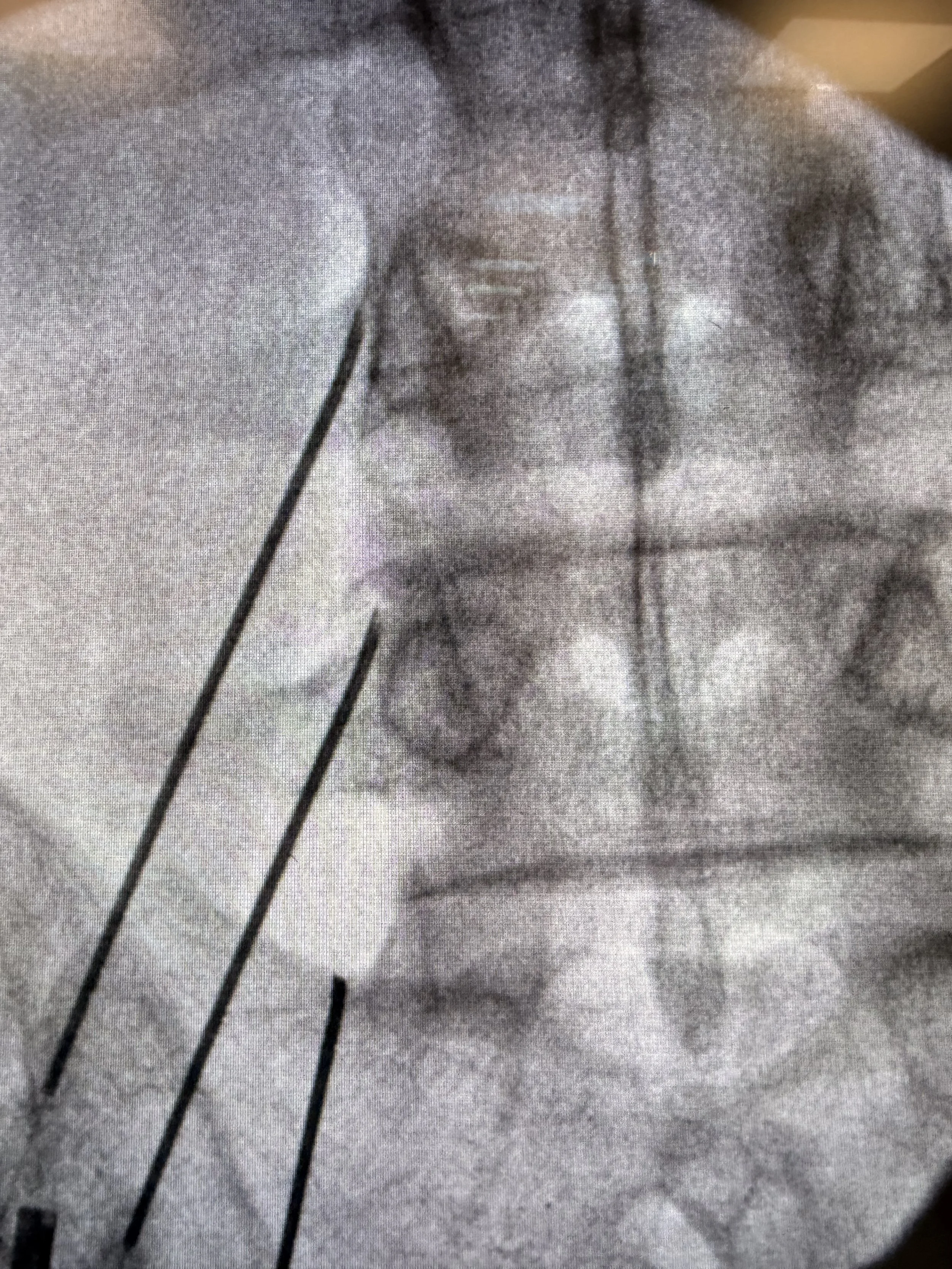 Medial Branch Blocks (MBB) &amp; Radiofrequency Ablation (RFA)