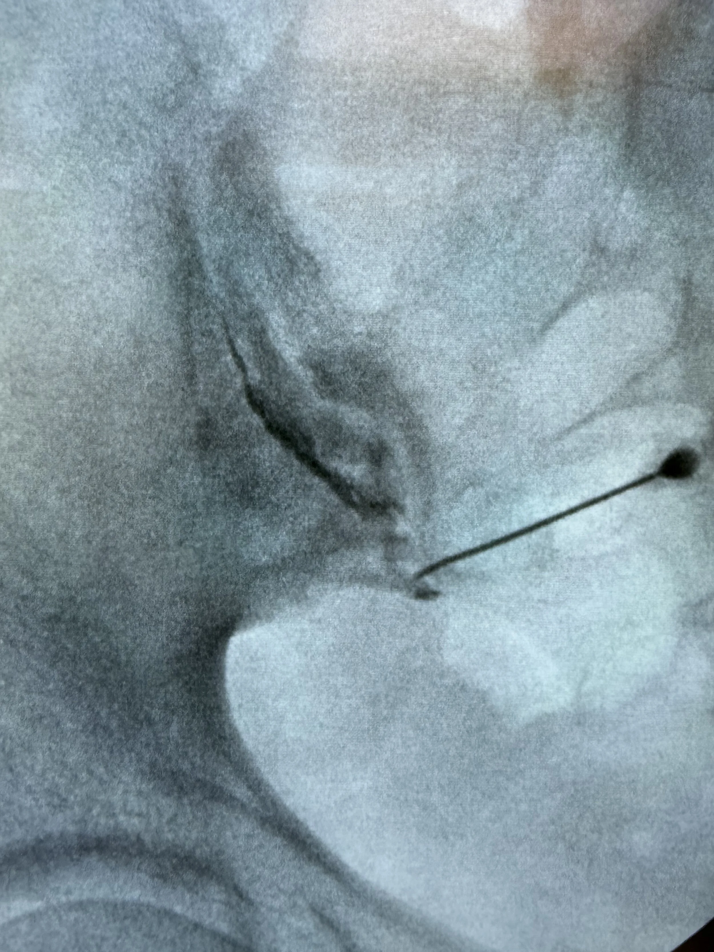 Sacroiliac Joint Injections