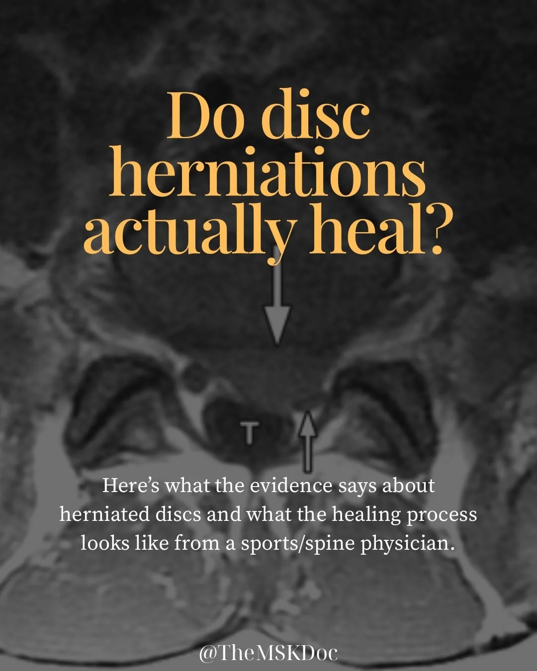 The number one question I get in clinic is probably - will my disc heal? 

The answer? More than likely, YES! However, that healing might not be exactly what you&rsquo;re expecting. 

#discherniation #herniateddisc #herniateddiscrecovery #themskdoc #