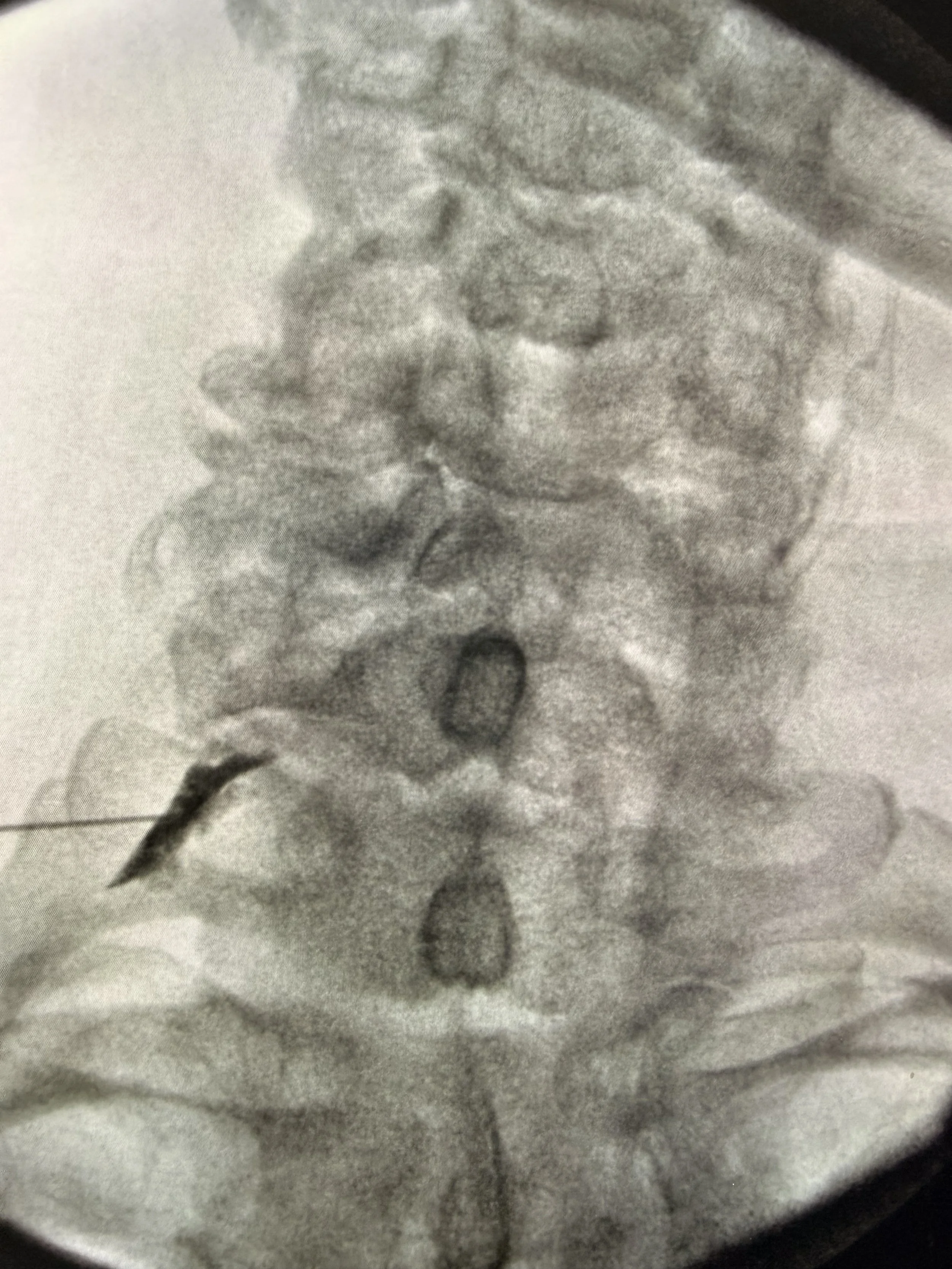 Epidural Steroid Injections